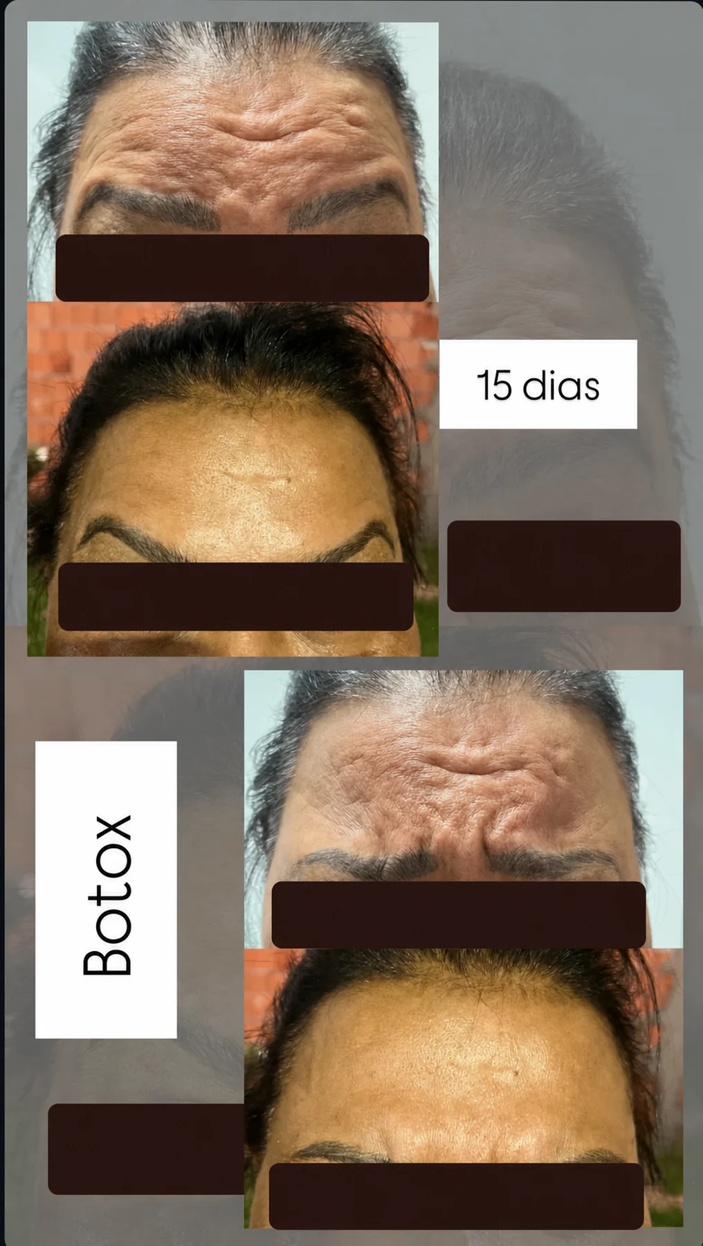 Comparativo da região frontal antes e depois de toxina botulínica com os olhos ocultados para privacidade