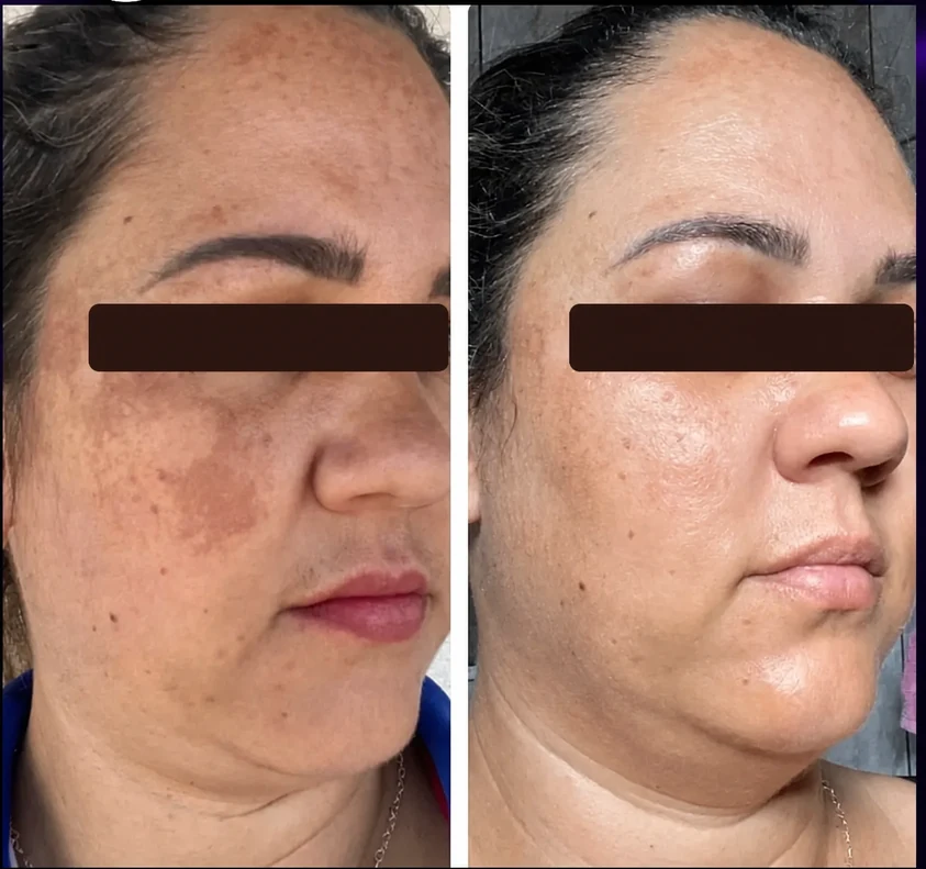 Comparativo facial de protocolo para melasma e manchas com a região dos olhos ocultada para privacidade