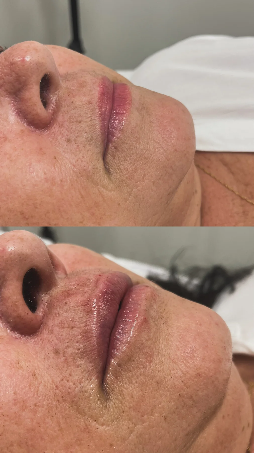 Comparativo de lábios antes e depois de preenchimento labial